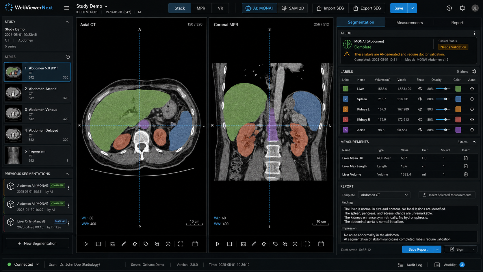 CT AI segmentation